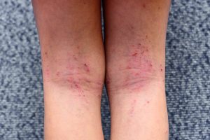 アトピーを専門に診察しております。